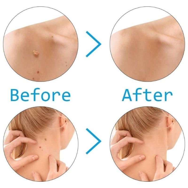 Home Micro Skin Tag Remover Set Traka Za Uklanjanje Bradavica S Kože Srednje Veličine S Tijela