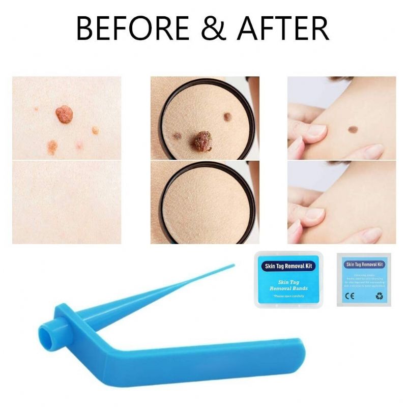 Home Micro Skin Tag Remover Set Traka Za Uklanjanje Bradavica S Kože Srednje Veličine S Tijela
